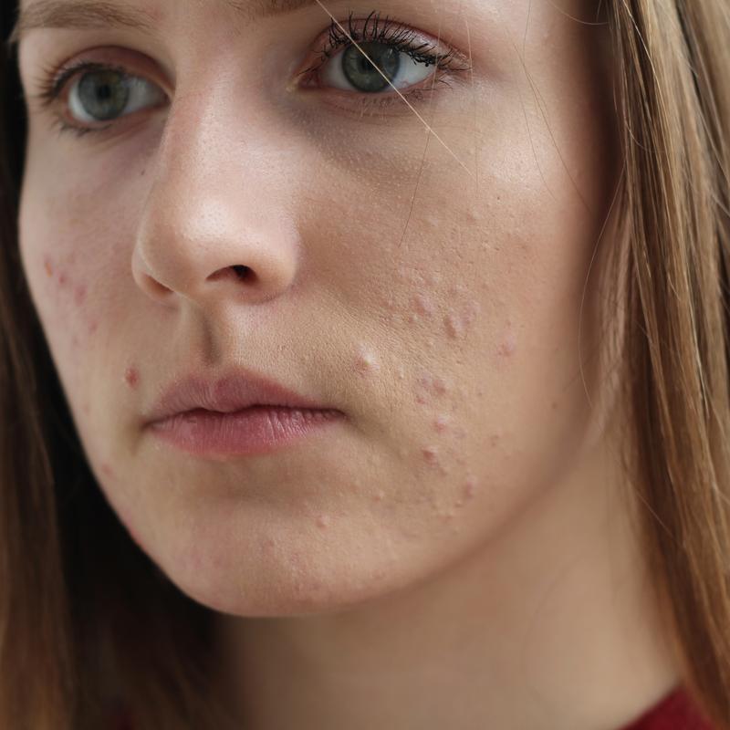 Jak leczyć wrzody na twarzy?
