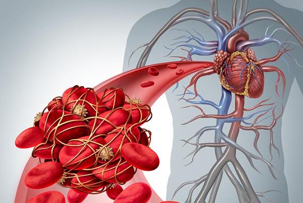 thrombosis_hajlam