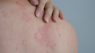 A csalánkiütés egy gyakori bőrtünet. A bőr középső rétegében jön létre a vizenyő, amely az erek áteresztőképességének fokozódása miatt alakul ki. A kiütések alakja a csalán által okozott hólyagokra emlékeztet.