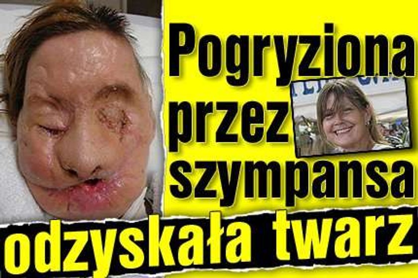 Pogryziona przez szympansa odzyskała twarz