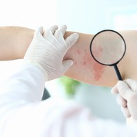 Bőrgomba, gombás bőrfertőzés: tünetei, okai és kezelési lehetőségei