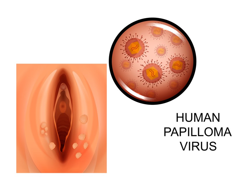 hpv pozitív kezelés