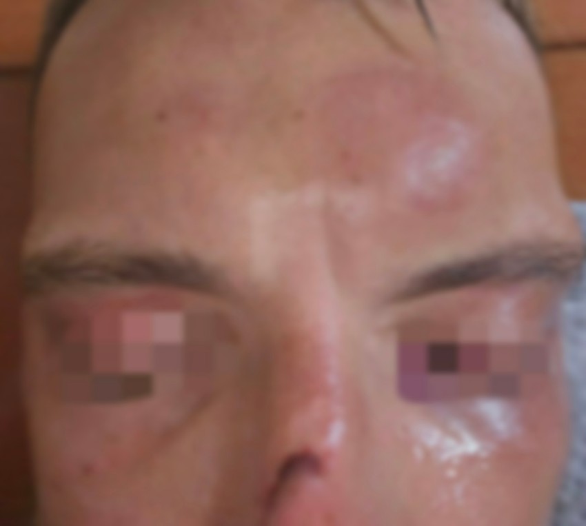 Povrede nosa i lica nakon pada sa trotineta