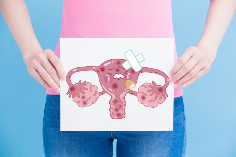 Endometrioza dotyka coraz większej ilości kobiet, a może jest po prostu częściej diagnozowana, bo wzrosła świadomość lekarzy i pacjentek