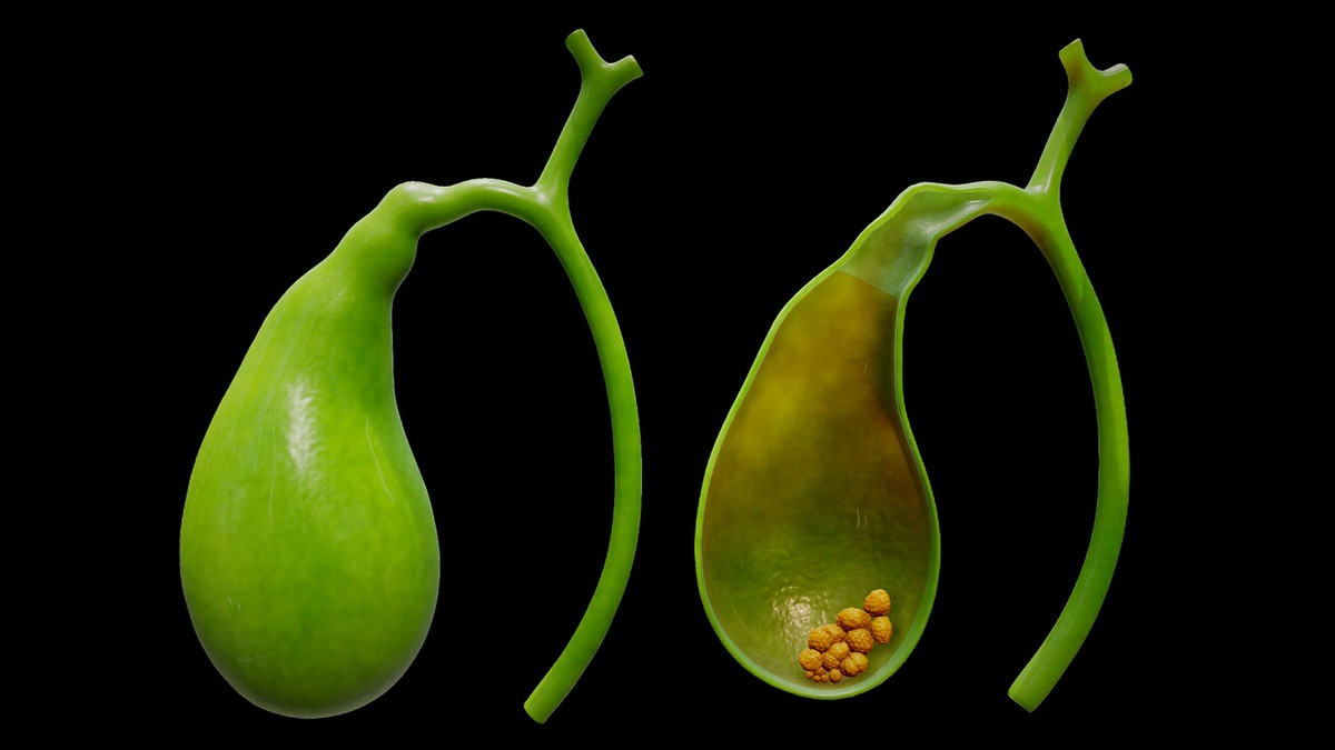 Rak žučne kese - mučnina i uporan bol u stomaku prvi simptomi kacinoma ...