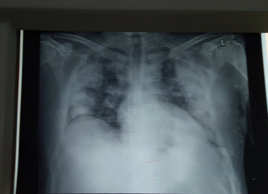 Rendgen snimak pluća obolelog od kovida 