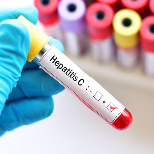 A hepatitis C vírus tünetei: korai diagnózis, teljes gyógyulás