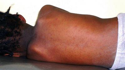 Measles kills 42 children in Adamawa, Govt extends resumption date to May 13 (Wikimedia)
