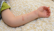 Najczęstsze przyczyny poparzeń wśród dzieci - co mówią badania?