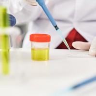 Hogyan lehet befolyásolni a vizelet fajsúlyát?