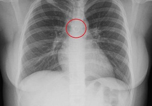 Imala je hroničan kašalj, a kad su lekari uradili snimak pluća zamalo nisu pali sa stolice