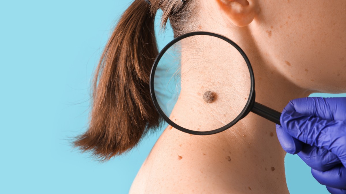 Određene karakteristike mladeža mogu da ukazuju na melanom