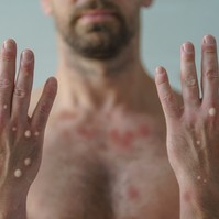 Majomhimlő: már 13 ezernél is többen elkapták az USA-ban