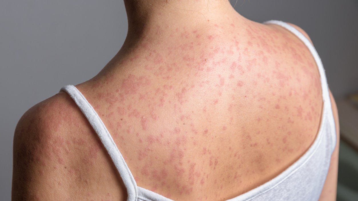 V posledných rokoch sa znížila miera zaočkovanosti proti osýpkam. (ilustračné foto)