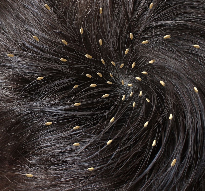 Masz to na głowie i szyi? Uważaj!