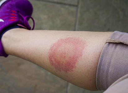 Lyme-kór: így zajlik a kullancsok által terjesztett betegség kezelése