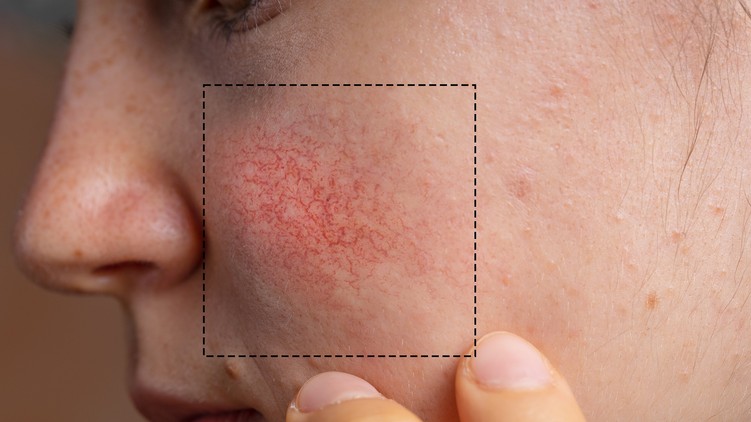 rosacea, nyár tünet belobban