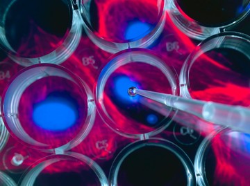 HIV: egy különleges eljárásnak köszönhetően egy 53 éves férfi kigyógyult a betegségből