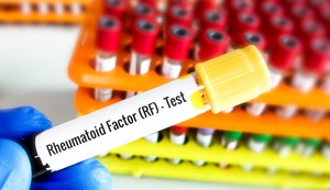 Reumatoidni faktor se testira pomoću analize krvi