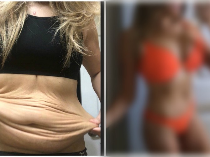 Melisa je nakon dva porođaja liniju dovela do savršenstva