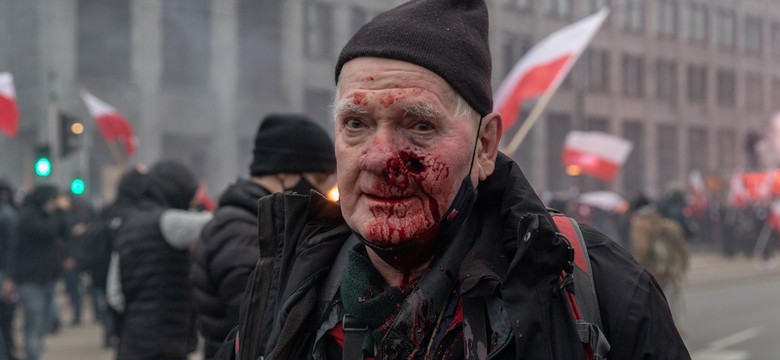 Zraniony przez policję fotoreporter: Będę żądał wysokiego odszkodowania. Może z sześcioma zerami