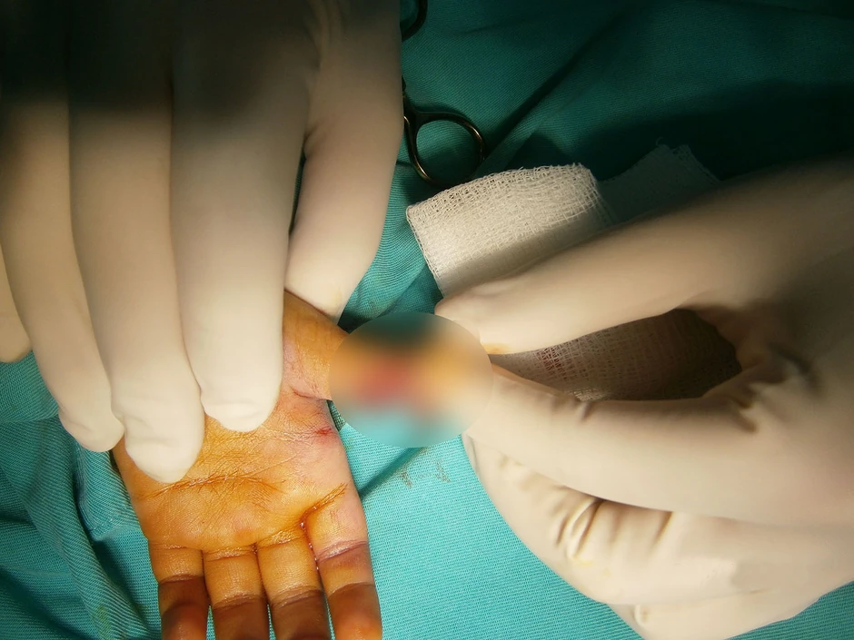 Zbog petardi deca ostaju bez prstiju, nekad i cele šake