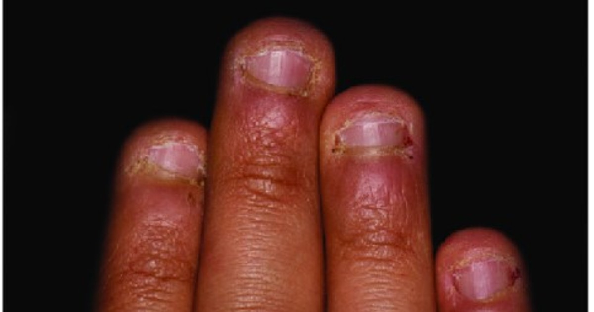 Tips on how to stop nail biting Pulse Ghana