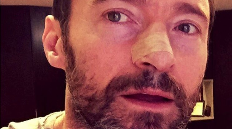 Hugh Jackman
legújabb fotóján az orra jobboldala van leragasztva / Fotó: Profimedia-Reddot