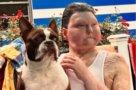 ŽIV JE GOREO, da bi ga spasili, lekari su mu transplantirali lice i ruke DUPLO STARIJEG ČOVEKA, ali on nije odustao od života i sada je STAO NA LUDI KAMEN sa ljubavlju svog života