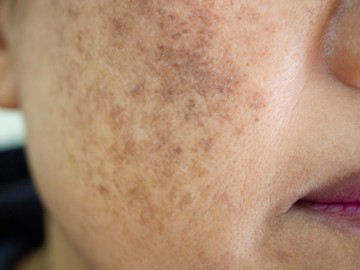 melazma, bőrfolt, foltok a bőrön, melanin, fényvédelem