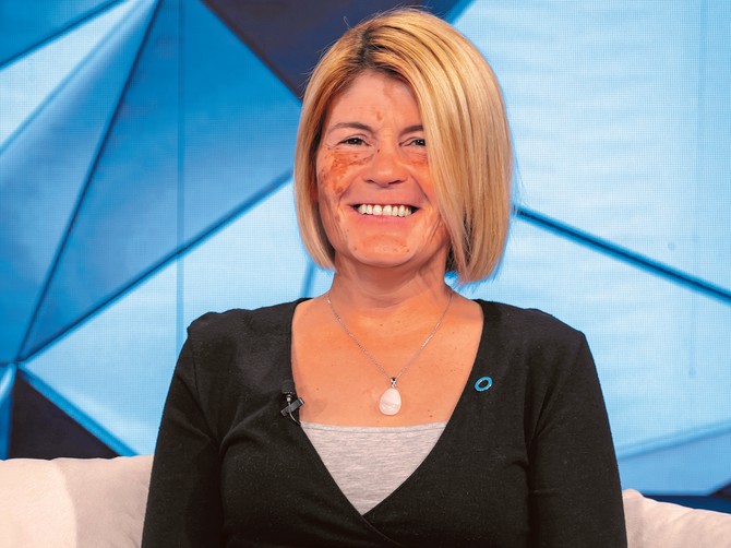 Bojana Marković ima vitiligo, a u "Blic žena studiju" okriva; "Ljudi vas gledaju sa gađenem"