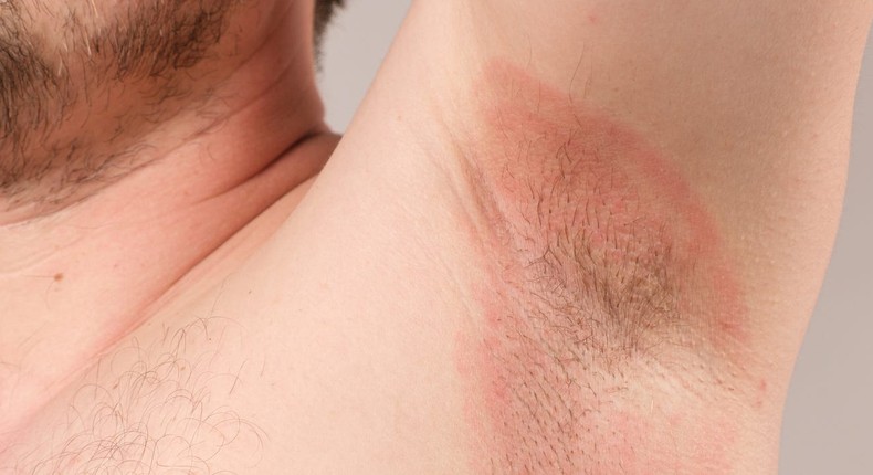 A yeast infection can cause a bright red rash on your armpits.Zarina Lukash/Getty Images