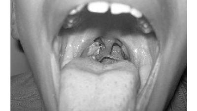 Bauchi govt confirms 2 Diphtheria deaths/Illustration. [SemanticScholar]