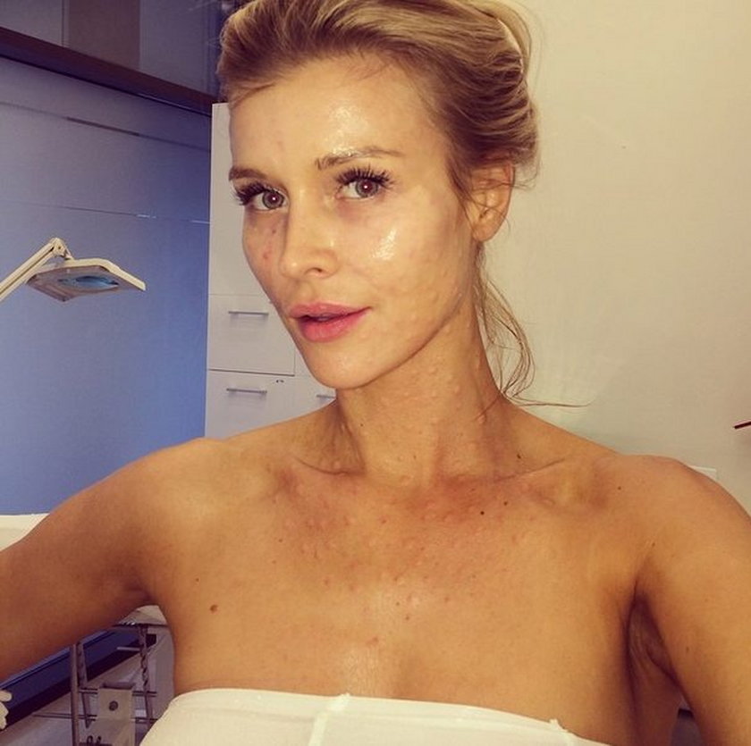 Joanna Krupa na wampirzym liftingu - instagram