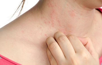eczema-all-you-need-to-know-pic_0