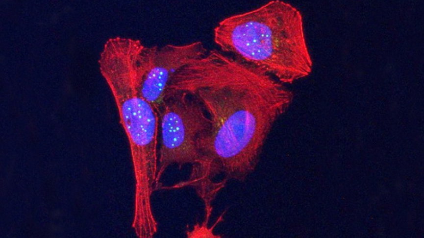 Na zdjęciu jedno z nowo odkrytych białek sygnałowych wytwarzanych przez telomery (białko VR - zielonkawe kulki). Białko to gromadzi się w jądrach (niebieskie owale) komórek nowotworowych (zabarwionych na czerwono), fot. Griffith Lab, UNC Lineberger