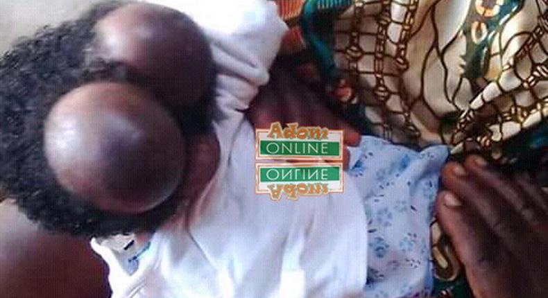 20-year-old woman gives birth to baby with two heads at Swedru