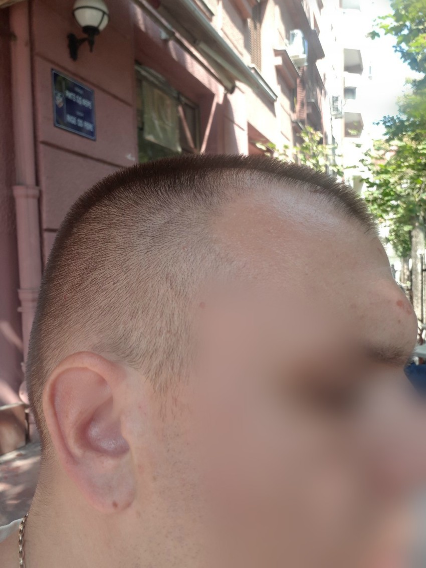 Beograđanin D. K. zadobio je povrede glave kada ga je radnik "kašikom" bagara udario po glavi