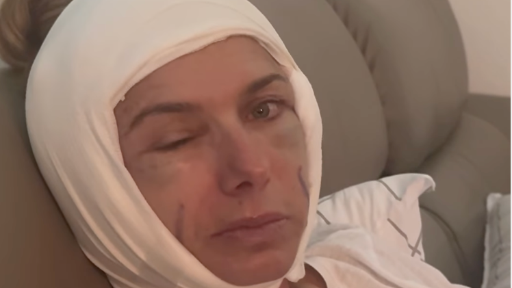Herečka Alice Bendová po Deep Plane Facelifte.