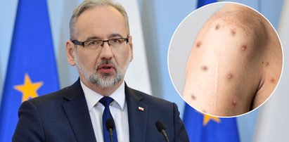 Pilne! Minister Niedzielski: Mamy pierwszy przypadek małpiej ospy w Polsce