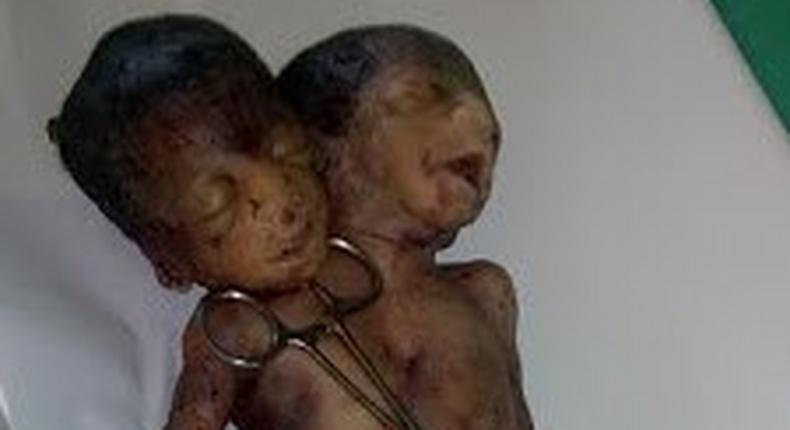 The deceased newborn twins