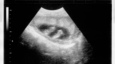 Efekt wyroku TK: Więcej aborcji, mniej badań genetycznych