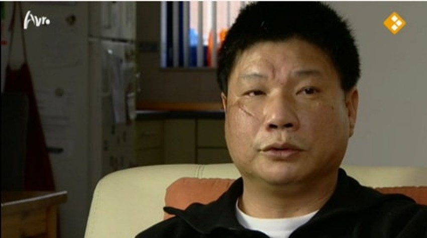 Otac ubijene devojčice ima ožiljak na licu posle napada