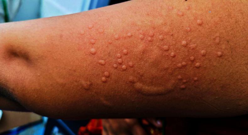 Symptoms of Mpox