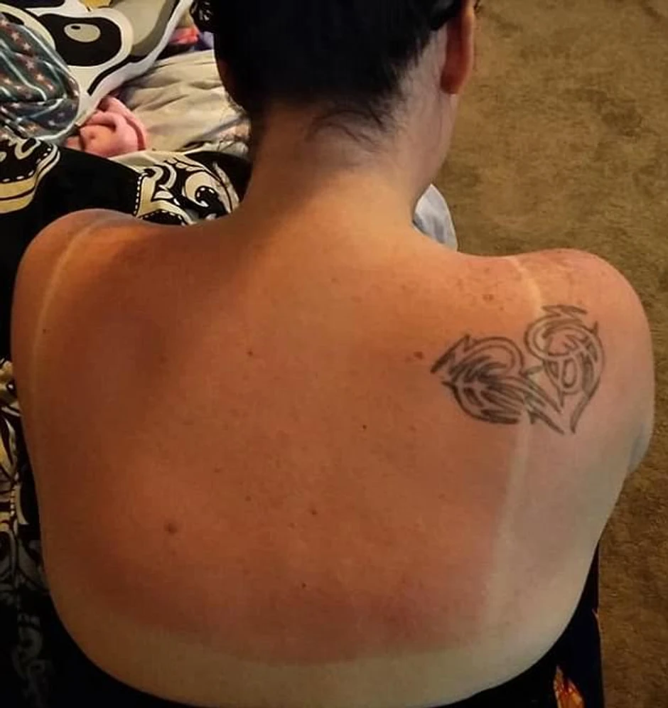 Sindine opekotine od sunca