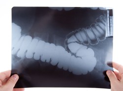 Nawet 60 proc. przypadków raka jelita grubego jest konsekwencją otyłości i...