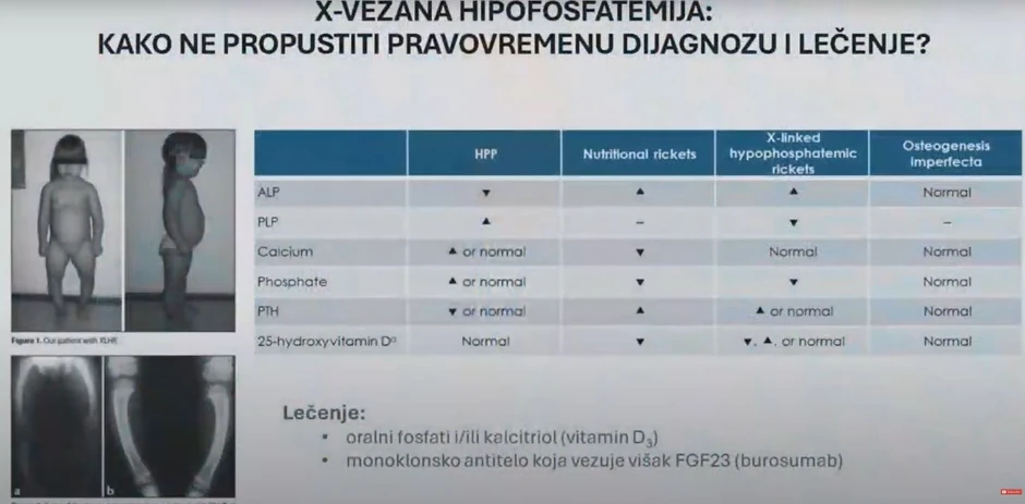 Prepoznavanje retkih bolesti po izgledu nogu
