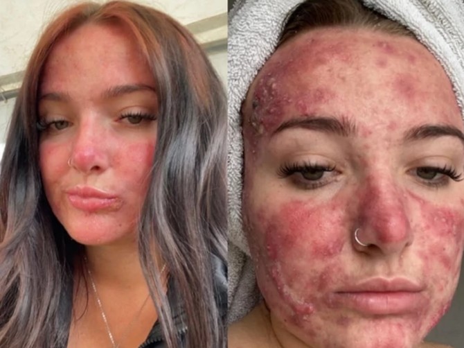 Imala sam stravične akne, zvali su me pizza face, a sada me prati milion ljudi