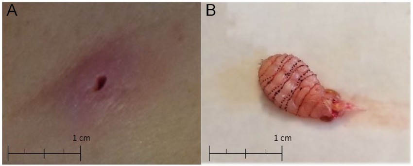 Larva je izvađena iz tela žene nakon dva meseca