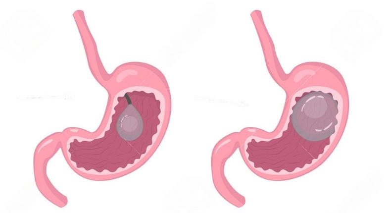 Step-by-step gastric balloon insertion process in Nairobi, Kenya.